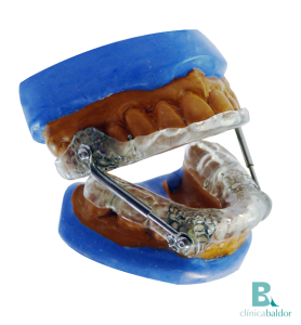 Dispositivo Ortopédico de Avance Mandibular (DOAM)
